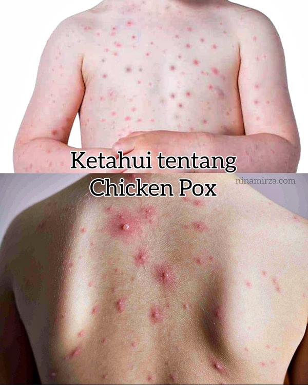 chicken pox