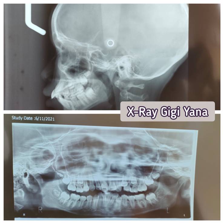 x-ray gigi